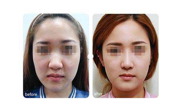 下頜角重塑：手術(shù)前后需要注意的事項