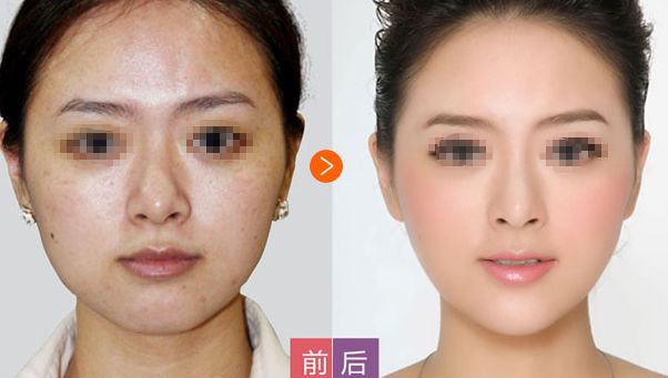 隆鼻手術(shù)后的修復(fù)期：經(jīng)驗(yàn)分享