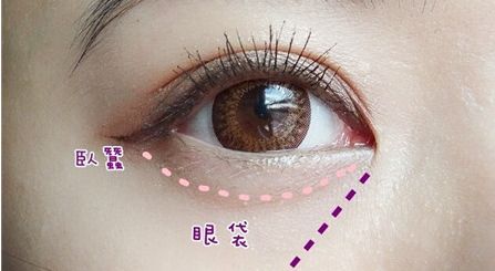 提升眼部神采！揭秘上瞼下垂手術(shù)的科學原理