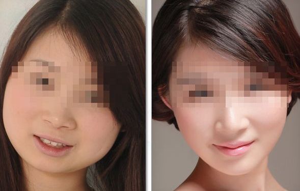 透明質酸隆鼻：安全有效還你完美鼻型