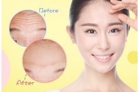 開內(nèi)眼角手術(shù)的疼痛程度如何？解析內(nèi)眼角手術(shù)的全貌