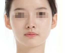 愛貝芙注射的絕佳效果時間揭秘