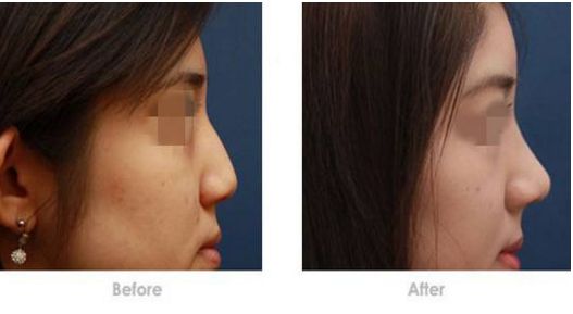 整形手術(shù)費(fèi)用和項(xiàng)目詳解，帶你了解價(jià)格和項(xiàng)目?jī)?nèi)容