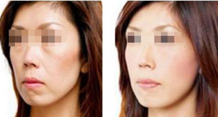 術(shù)后脂肪填充面部消腫時(shí)長(zhǎng)及護(hù)理指南速查