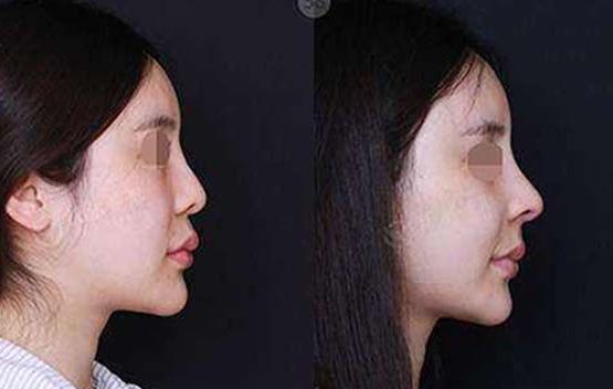 醫(yī)學美容，提升面部輪廓選什么材料效果好？持久效果如何？