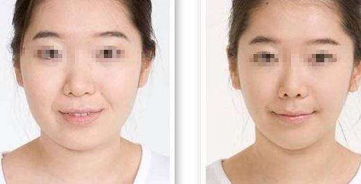 隆鼻手術(shù)失敗，修復(fù)需謹(jǐn)慎，風(fēng)險(xiǎn)不可忽視