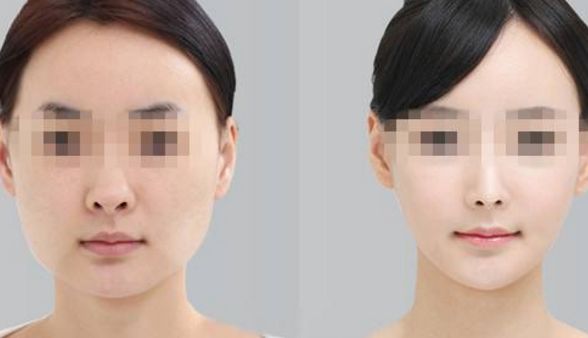 去眼袋手術(shù)后，會有疤痕嗎？術(shù)后眼部腫脹情況探析