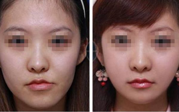 透明質(zhì)酸注射隆鼻，讓你散發(fā)青春魅力