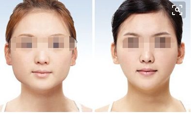 透明質(zhì)酸隆鼻：如何有效延長效果期限？自體軟骨隆鼻：維持力究竟有多久？