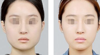 填充鼻唇溝使用玻尿酸安全又有效嗎？