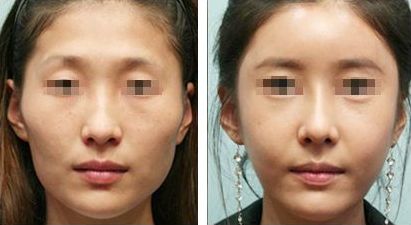 雙眼皮修復(fù)的關(guān)鍵時期，如何有效解決手術(shù)失敗問題？