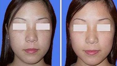 祛除眼袋與抽脂術(shù)哪種更有效？