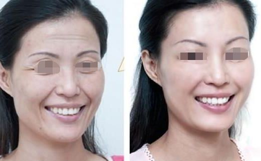 面部吸脂瘦臉效果如何？達(dá)到自然效果的關(guān)鍵是什么