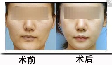 鼻骨矯正對外貌有何影響？矯正費用合理嗎？