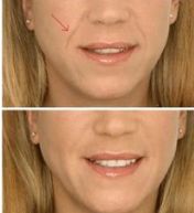 果酸換膚：副作用和危害揭秘，怎樣保護(hù)肌膚安全