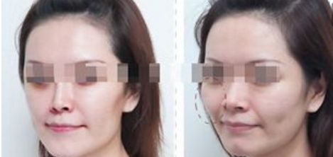 隆鼻修復(fù)術(shù)后一周有哪些注意事項