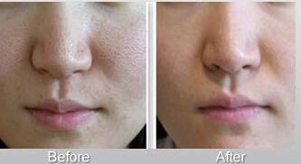 鼻整形手術(shù)后恢復(fù)需要多久？隆鼻與注射隆鼻的恢復(fù)時間對比！