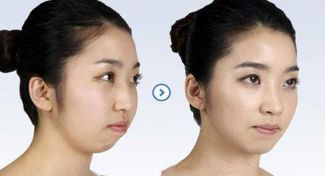 祛除紅血絲的高效療法，讓肌膚重見光彩！