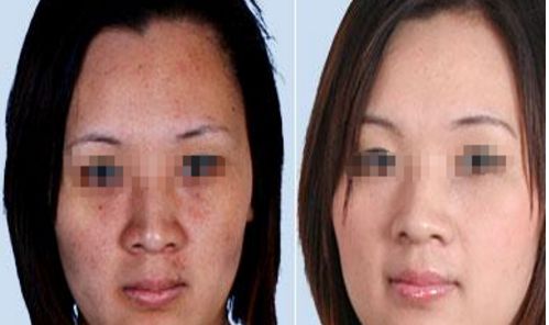 透明質(zhì)酸隆鼻手術(shù)：安全高效的注射方式介紹