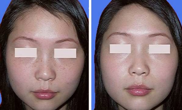 假體隆鼻：消腫周期及價格解析