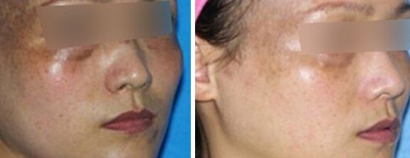 熱瑪吉和黃金超聲炮有何不同？揭秘引發(fā)90%人搞混的區(qū)別！