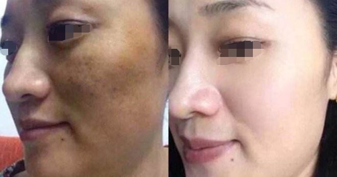 淚溝填充：熊貓針VS膠原蛋白，手術(shù)過(guò)程與注意事項(xiàng)解析