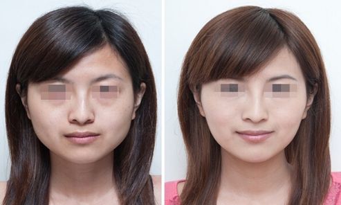 外耳重建手術(shù)費(fèi)用及疼痛情況簡述，攻略來襲！