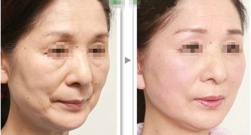 解脂能祛眼袋嗎？多少錢？功效與注意事項(xiàng)詳解