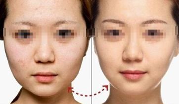 陰道緊縮術(shù)療程多久見效？