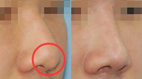 耳再造手術：解密過程與輪廓失真問題解析