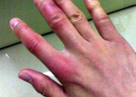 耳廓再造術(shù)前的準(zhǔn)備攻略解析