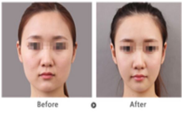 自體脂肪豐胸方案靠譜嗎？恢復時間需要多久？美胸關(guān)鍵要點一覽！