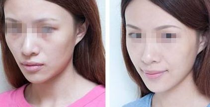 祛眼袋吸脂術后恢復需要多少時間