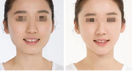 鼻整形手術(shù)價格分析：效果原理講解，術(shù)后注意事項，不良反應(yīng)剖析