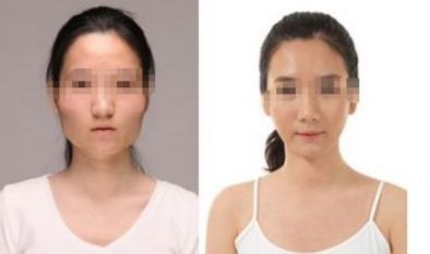 開(kāi)眼角手術(shù)：完美改善眼部形態(tài)的秘密解析