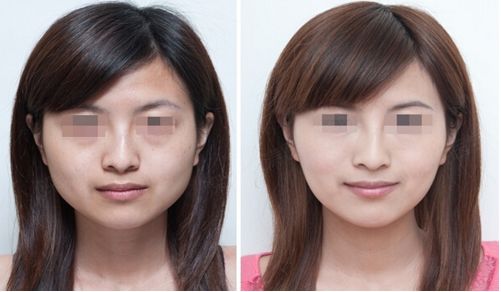 隆鼻手術(shù)后恢復(fù)需要多久時間呢？