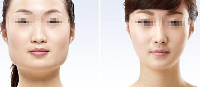 有效去除咬肌的兩種方法，輕松擁有優(yōu)美小臉