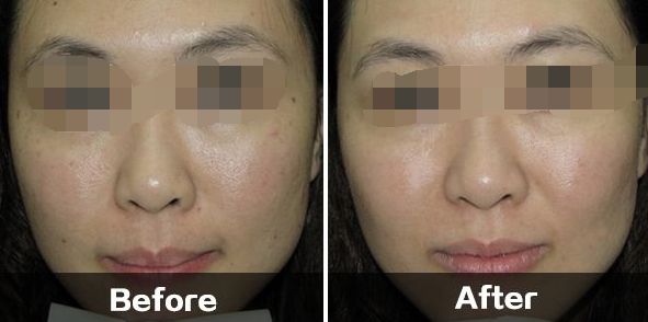 夏季控油護膚攻略，上海醫(yī)美整形控油方法一覽