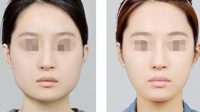 果酸換膚，讓你重獲肌膚煥新！注意事項(xiàng)與過(guò)程詳解