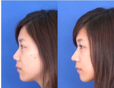 女明星追捧｜熱瑪吉：抗衰神器功效與副作用揭密！