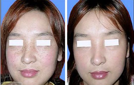 眼部上瞼下垂原因分析及改善方法總結(jié)