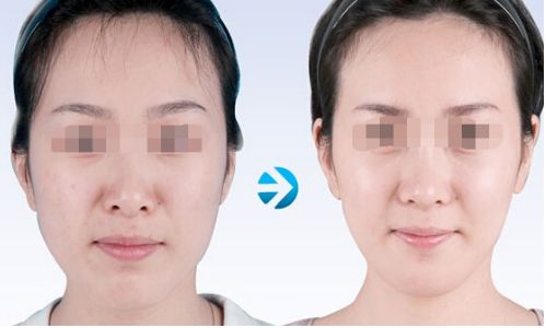 激光祛疤：了解效果如何，專業(yè)分享解析