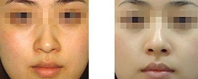 潤百顏：性價高國產(chǎn)玻尿酸測評，你值得擁有！