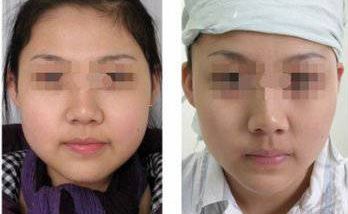 硅膠假體隆胸手術(shù)：效果如何？安全程度如何評(píng)價(jià)？