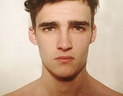 透明質(zhì)酸隆鼻手術(shù)后的腫脹現(xiàn)象及恢復(fù)過(guò)程概述