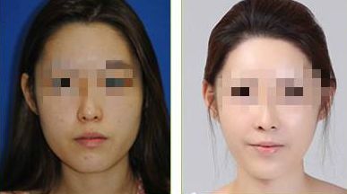 西寧華美整形腹部減脂，有效方法大揭秘！