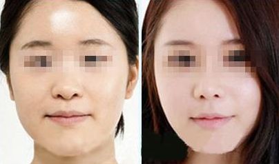 激光祛胡脂肪堆積有安全風(fēng)險(xiǎn)？您了解情況嗎？