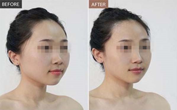 蘇州脈沖祛斑是怎么做的？這種激光祛斑的方法有哪些特點？