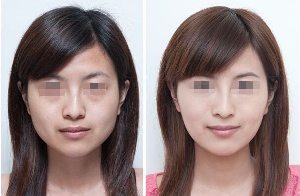 長曲線下頜角整形手術(shù)能否一次性進(jìn)行截骨操作