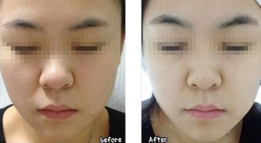 韓式微創(chuàng)無痕處女膜修復(fù)的效果如何？